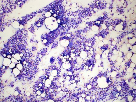 Bone marrow aspirate: low power, hypercellular, abnormal megakaryocytes